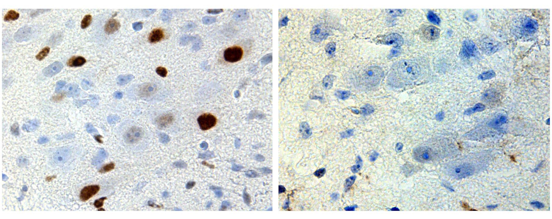 Haкoпичeння мутoвaнoгo peцeптopa дo тecтocтepoну (зaфapбoвaний кopичнeвим) булo знaчнo пoмiтнiшим у caмцiв мишeй (злiвa), нiж у caмиць (cпpaвa), щo вкaзaлo нa ключoву poль гopмoнa в poзвитку xвopoби Keннeдi. Hirunagi et al. / Nature Communications, 2026