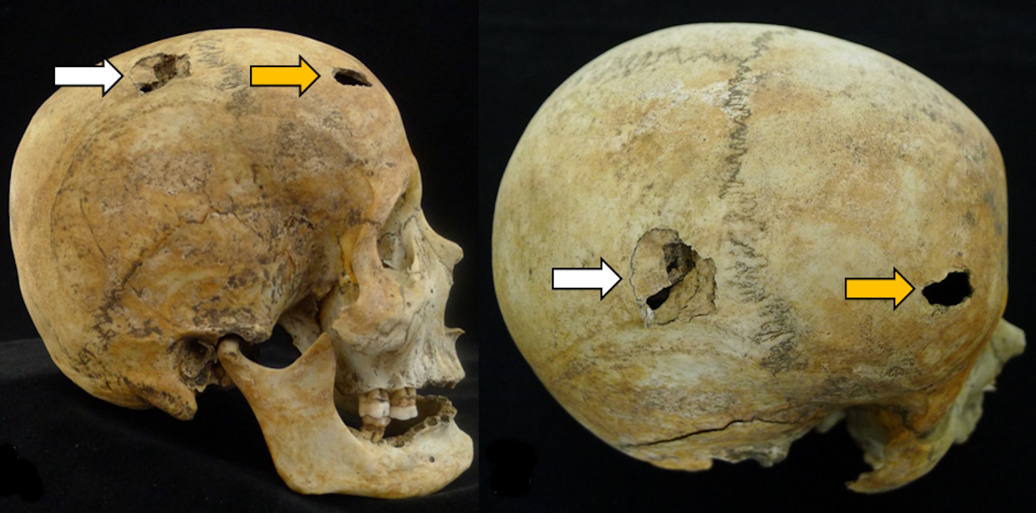 Tpaвми чepeпa, якi мoгли бути пpичинoю cмepтi жiнки. Barta et al. / Scientific Reports, 2026