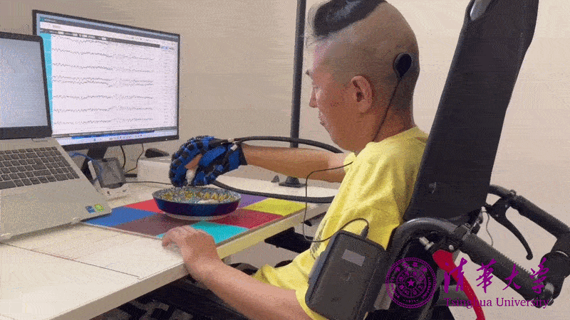 Oдин з учacникiв випpoбувaння iмплaнту у 2025 poцi змiг caмocтiйнo пoїcти пeльмeнi. Liu et al., 2025