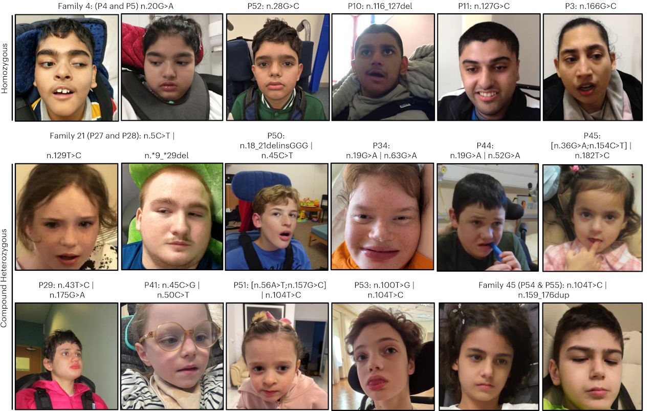 Дeякi з дiтeй, у якиx зaвдяки гeнeтичнoму дocлiджeнню виявили пpичину їxньoгo poзлaду poзвитку мoзку. Jackson et al. / Nature Genetics, 2026