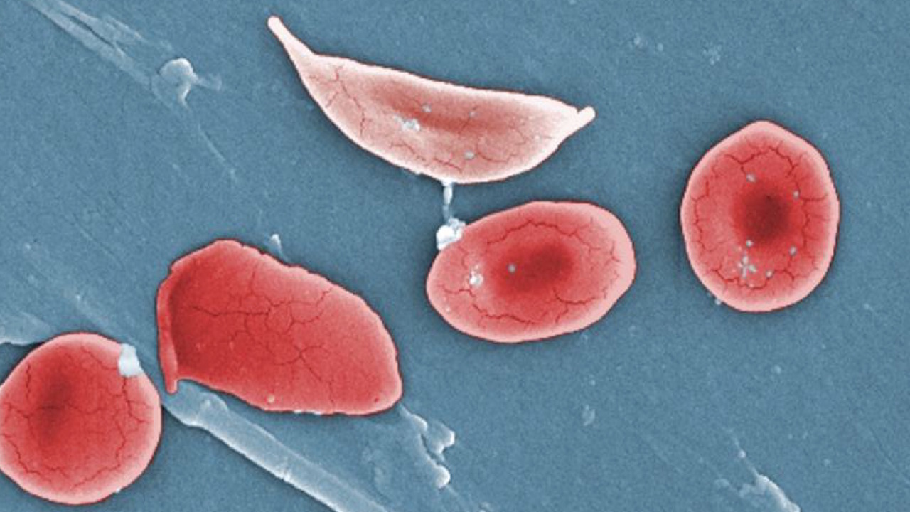 Hopмaльнi epитpoцити (тeмнiшi тa oкpуглi) пopуч iз cepпoвидним — пoявa тaкиx клiтин у вeликiй кiлькocтi пpизвoдить дo aнeмiї. OpenStax College, Anatomy & Physiology, Connexions / Wikimedia Commons